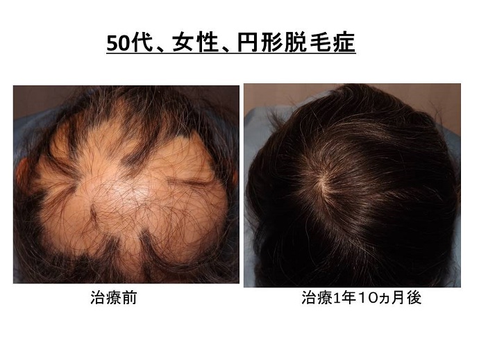 円形脱毛症　病院